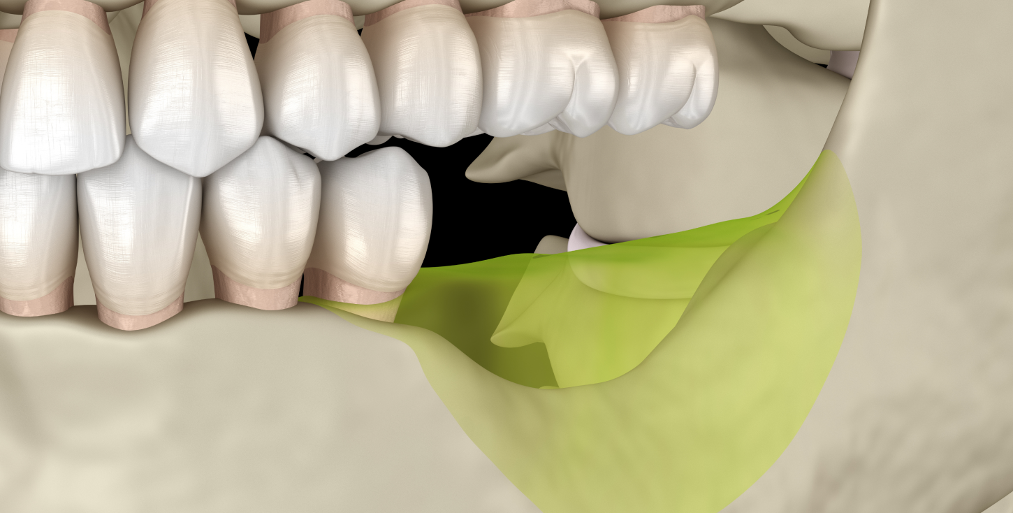 Apport osseux consolidant la zone à implanter — dentiste Le Beausset