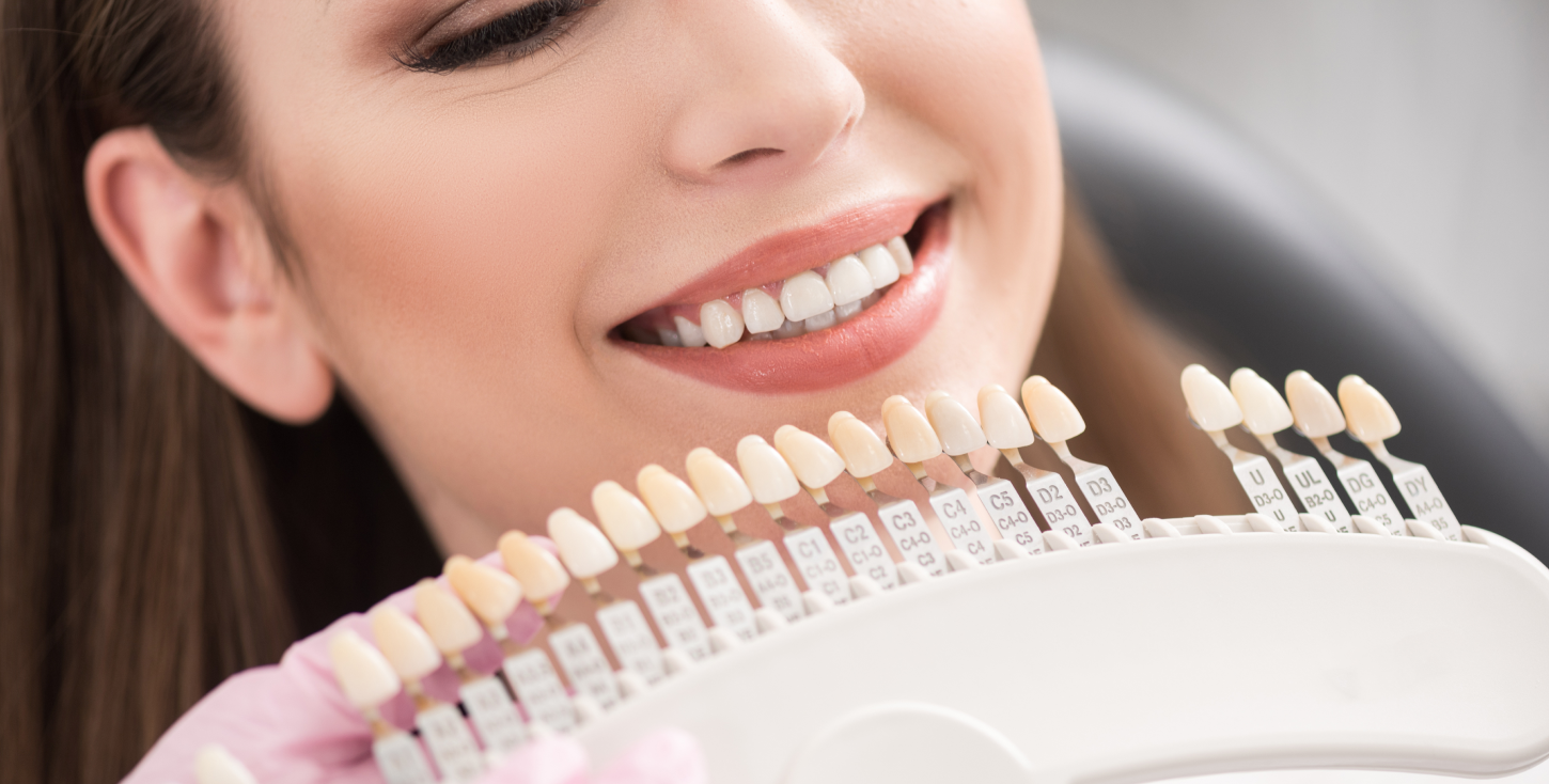 Facettes dentaires esthétiques pour harmoniser le sourire — dentiste Le Beausset, près de Toulon