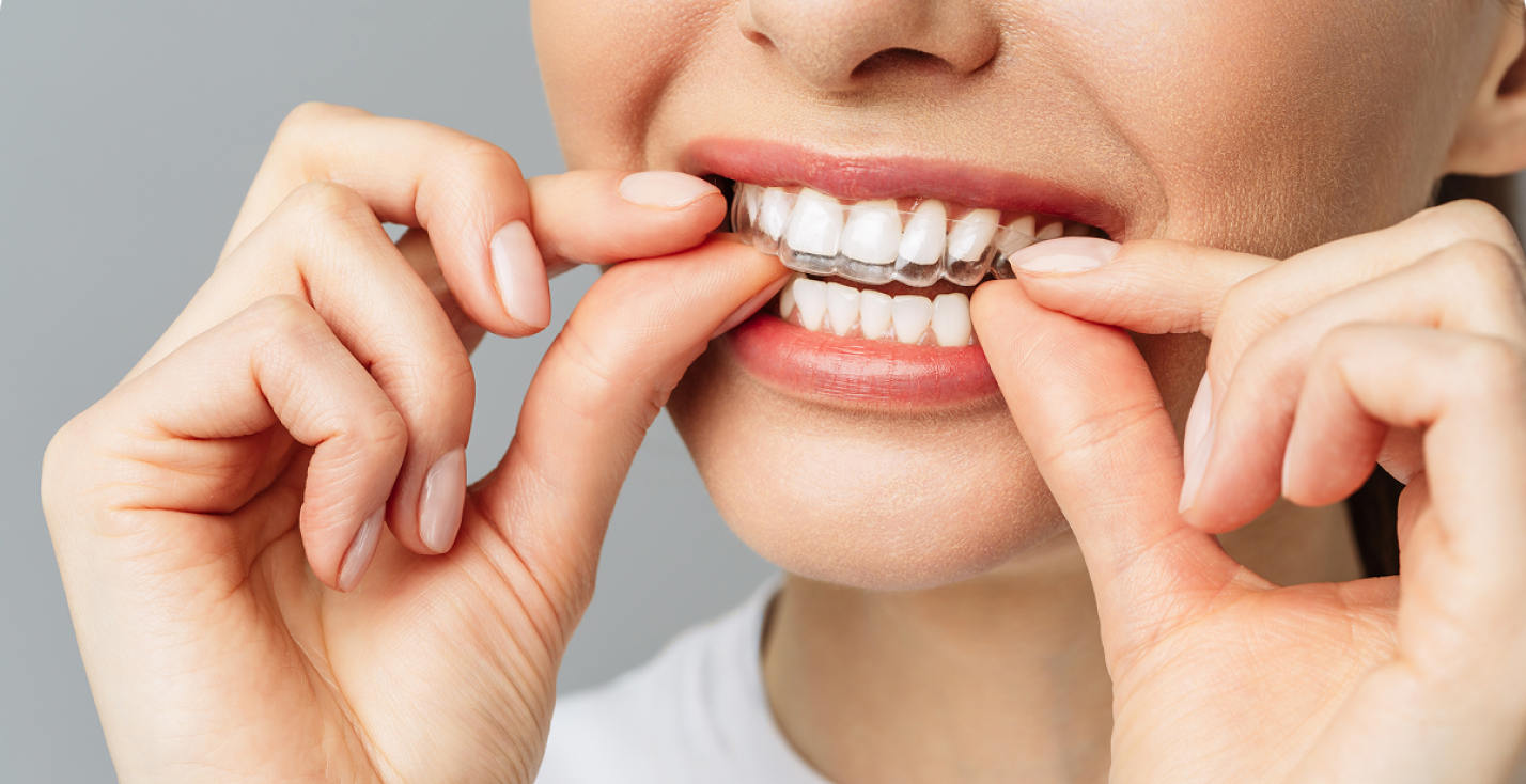 Gouttières orthodontiques transparentes sur une arcade dentaire — dentiste Le Beausset