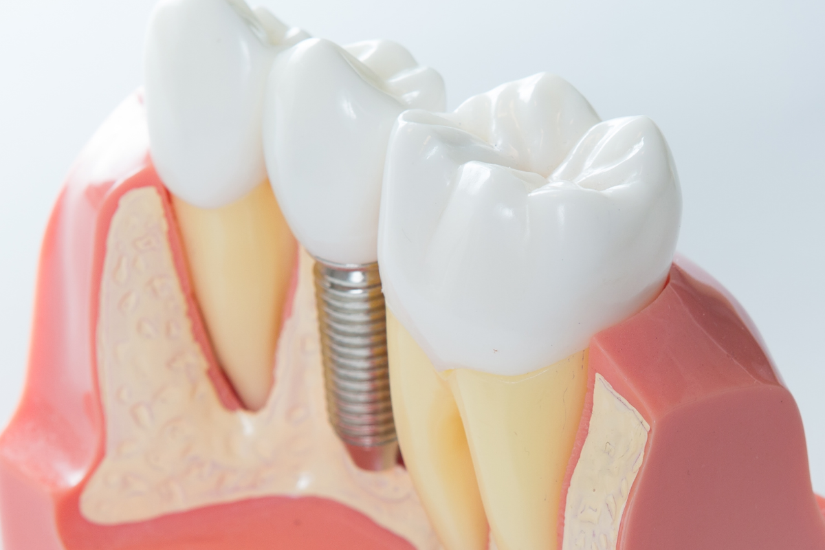 Implant en titane servant de racine artificielle — dentiste Le Beausset