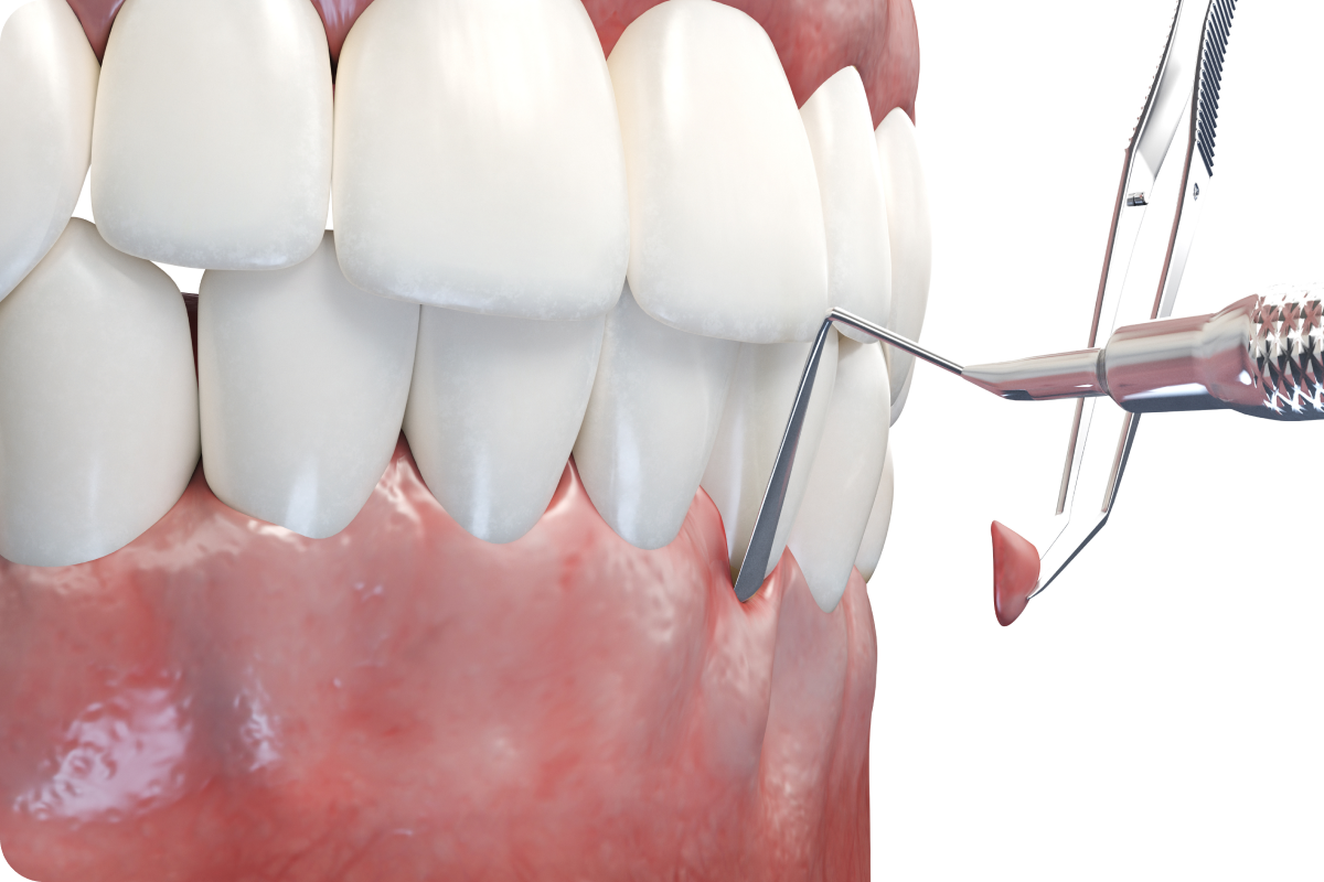 Correction d’une récession gingivale — dentiste Le Beausset